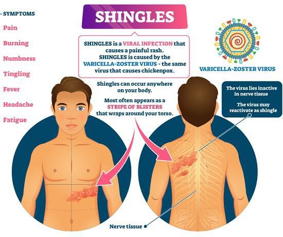 shingles symptoms