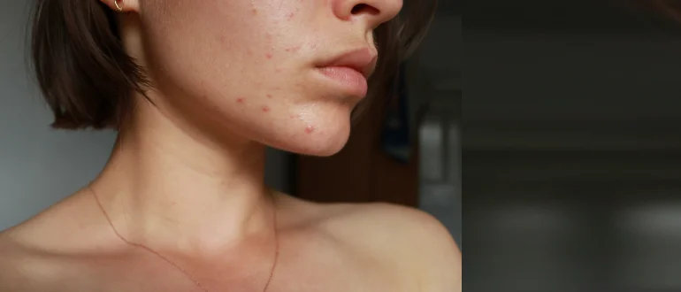 Acne Breakout Acne Breakout