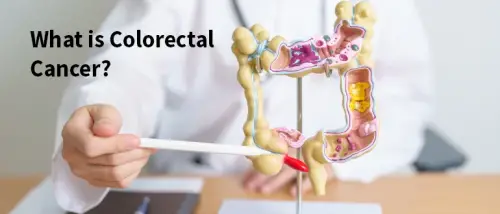 Colorectal (Colon) Cancer: Types, Symptoms, Stages and Treatment