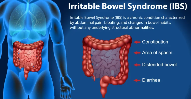 How Will I Know If I Have Irritable Bowel Syndrome Irritable Bowel Syndrome