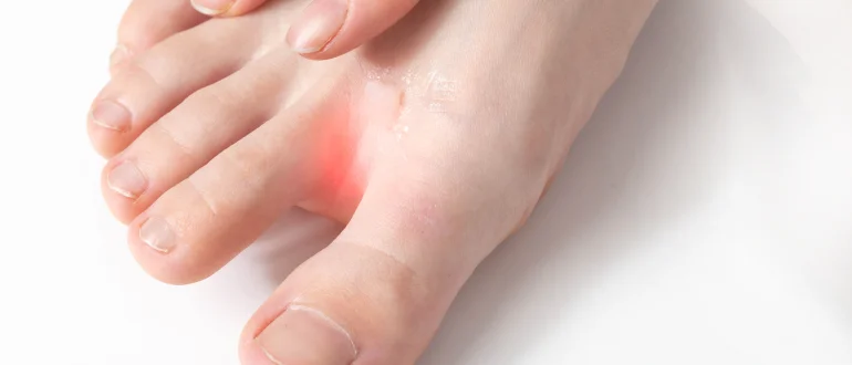 Intertrigo Intertrigo