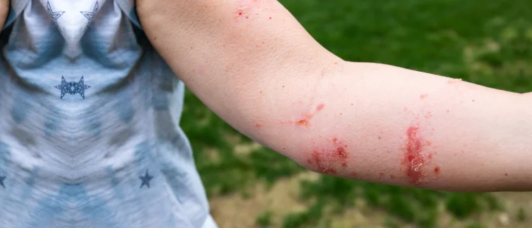 Plants-related Allergies Plants-related Allergies