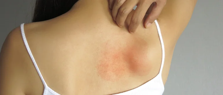 Prickly Heat Prickly Heat