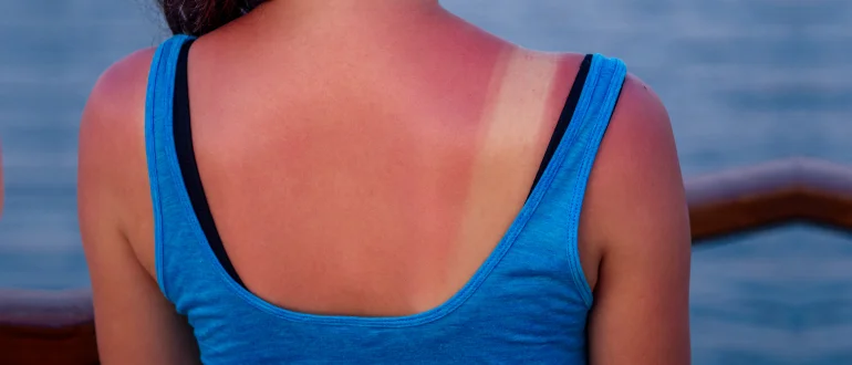 Sun Allergy Sun Allergy